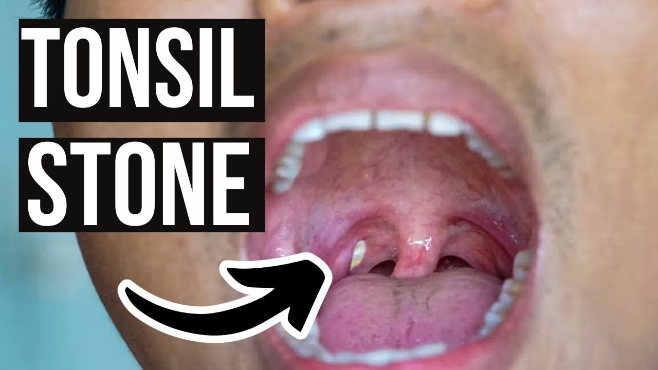 Effective Ways to Get Rid of Tonsil Stones at Home in 2025 – Discover Practical Methods!